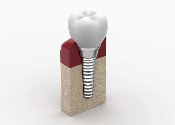 Understanding The Dental Implant Process